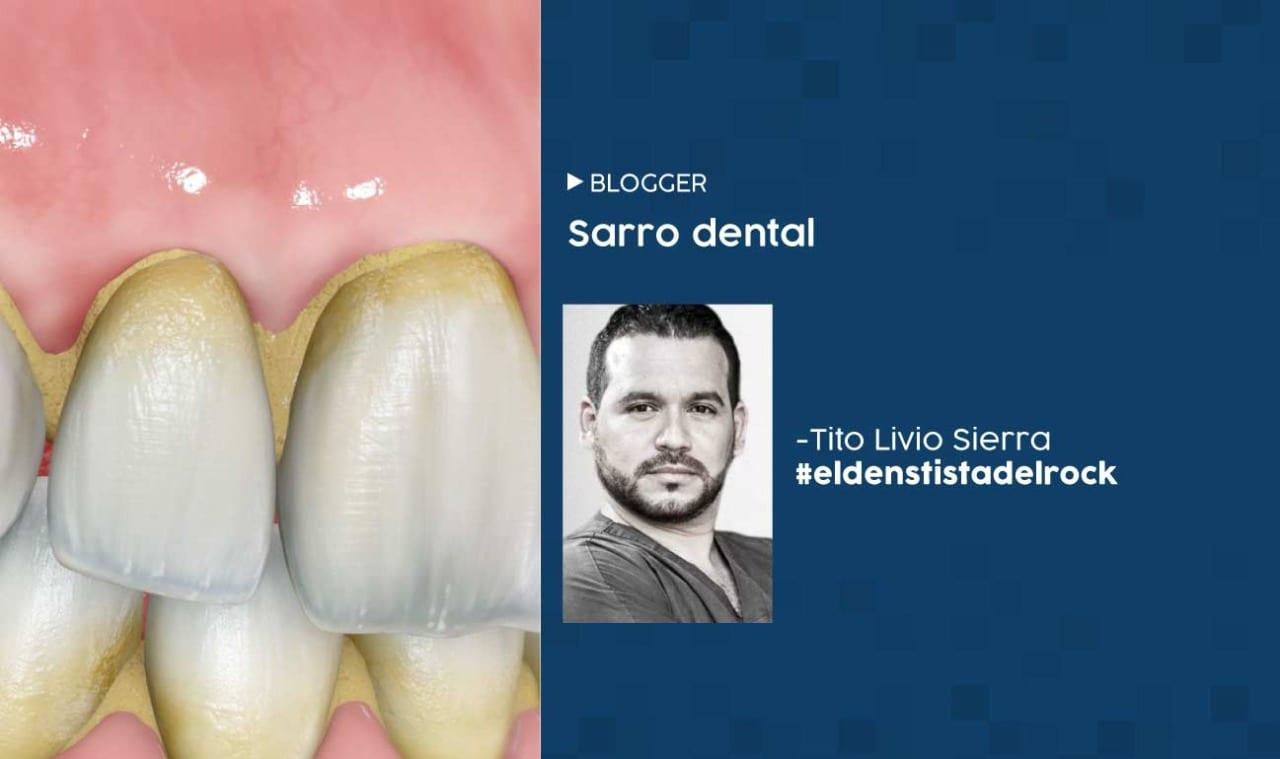 Imagen de Sarro dental: todo lo que debes saber y cómo sanarlo