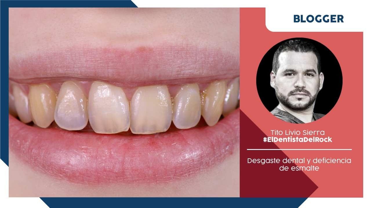 Imagen de Desgaste dental y deficiencia de esmalte