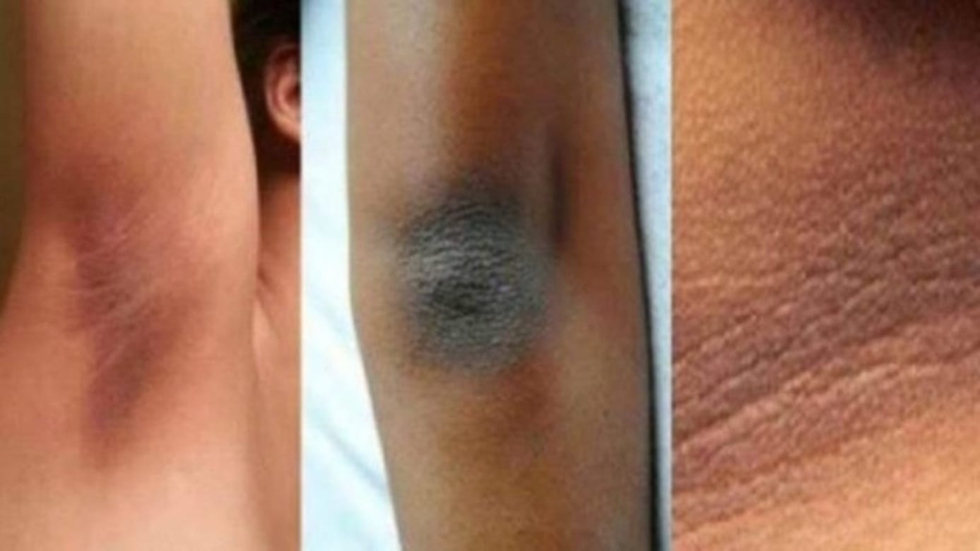 Imagen de ¿Por qué tienes manchas oscuras en el cuello y en otras partes del cuerpo?