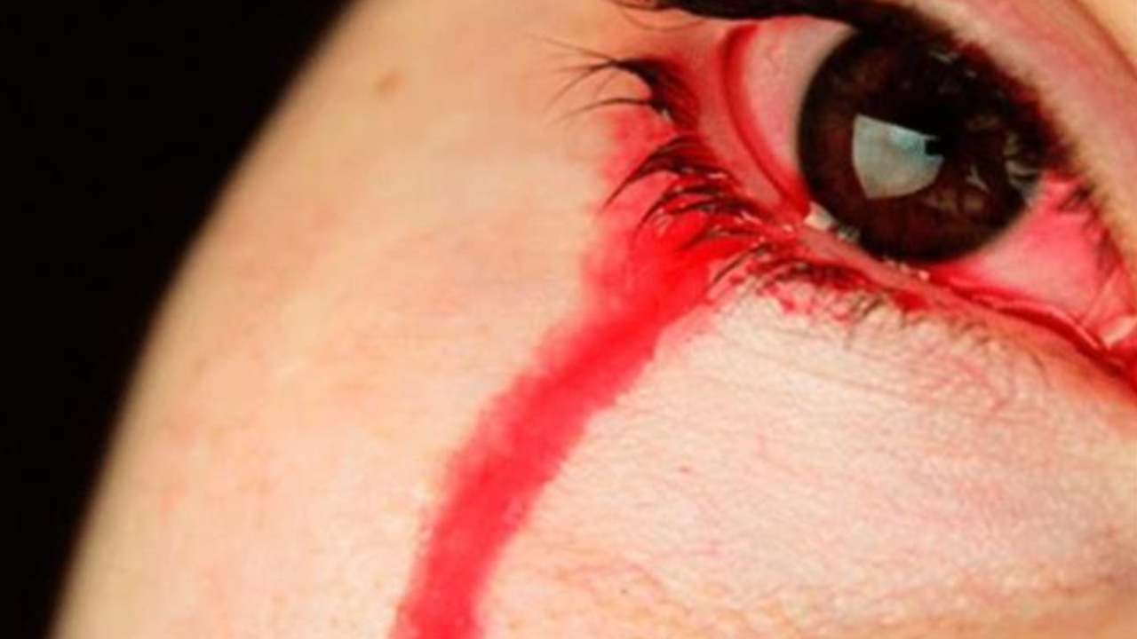 Imagen de El extraño caso de una joven que sangró por los ojos durante su período menstrual
