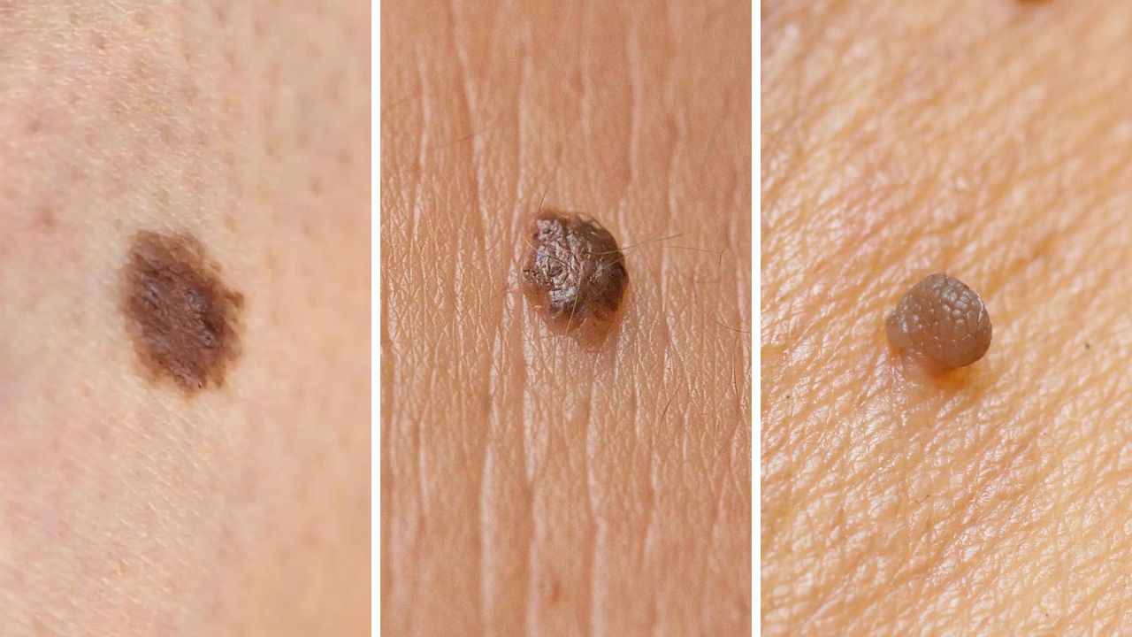 Conoce la diferencia entre un lunar, una verruga y un papiloma Imagen de Conoce la diferencia entre un lunar, una verruga y un papiloma