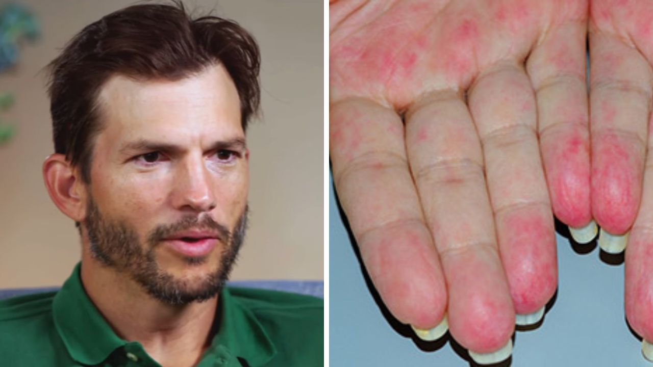 Imagen de Ashton Kutcher y la enfermedad autoinmune que lo dejó un año en cama