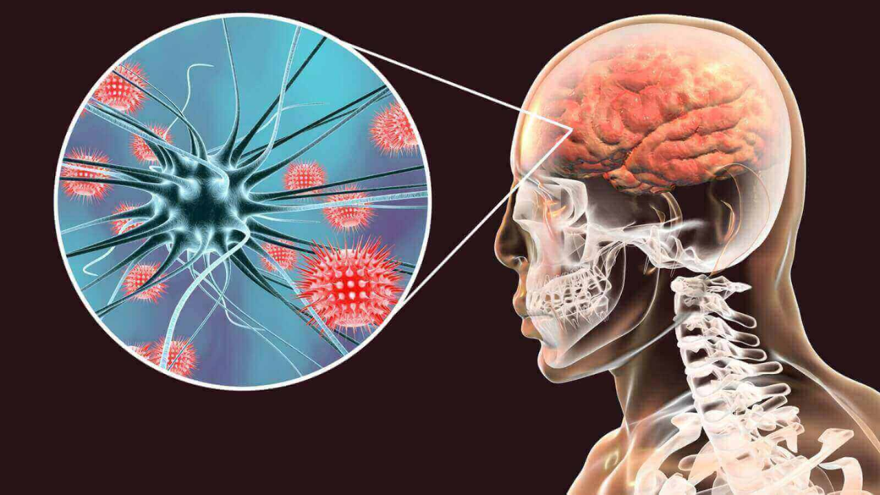 Imagen de ¿Qué es la Meningitis?, síntomas, cómo se diagnostica, tratamiento y prevención de la enfermedad