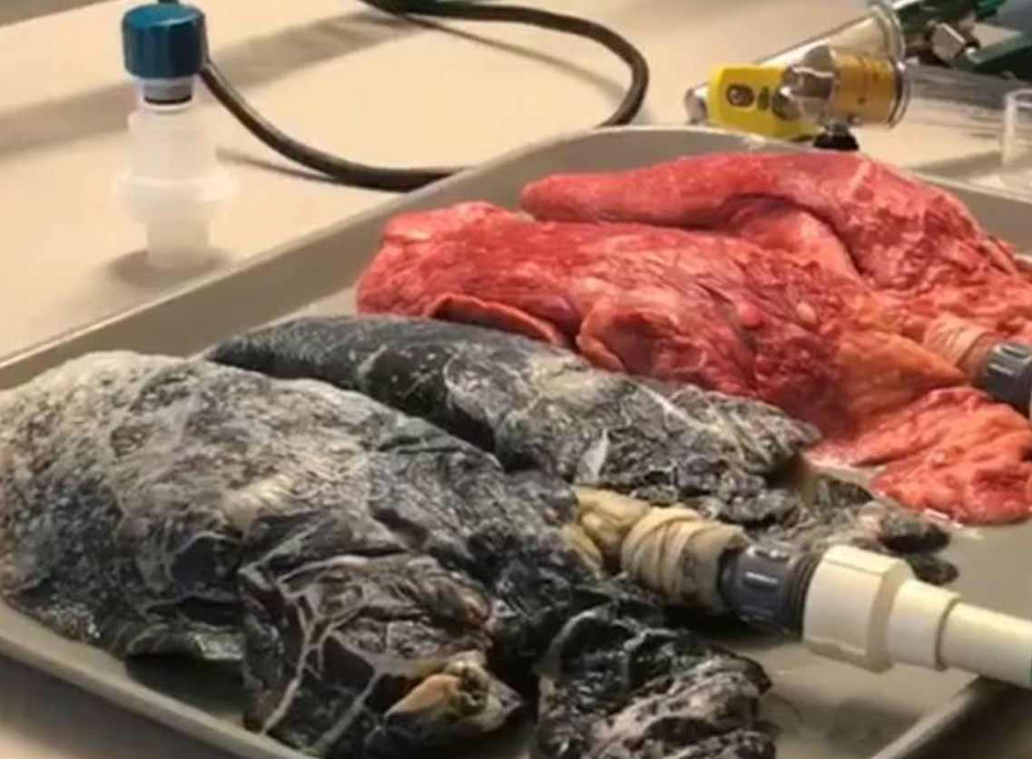 Pulmones de un fumador y los de una persona que no consume tabaco. Foto: El País
