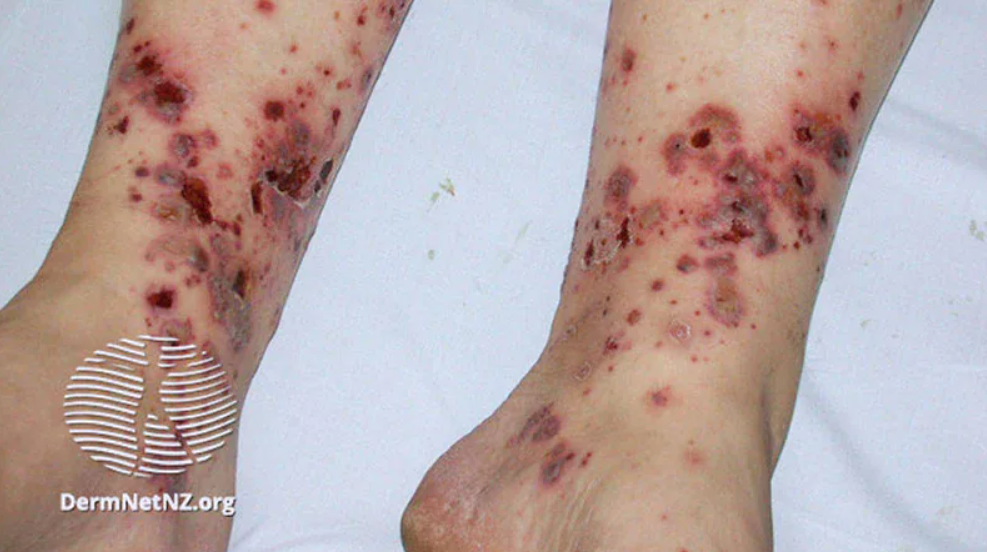 Vasculitis graves. Foto: DermNetNZ.org