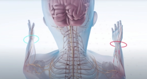 La esclerosis crea un deterioro grave en las personas que lo padecen. Foto: Medline Plus