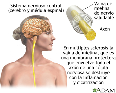 La mielina es una membrana protectora de las células nerviosas. Foto: Medline Plus