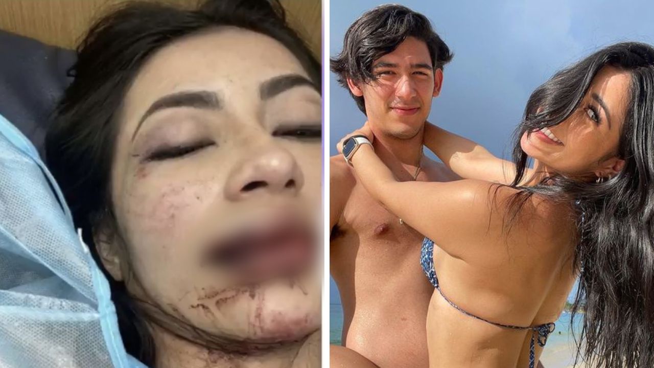 Daniela Aldana necesitará dos cirugías reconstructivas en su rostro Imagen de Daniela Aldana necesitará dos cirugías reconstructivas en su rostro