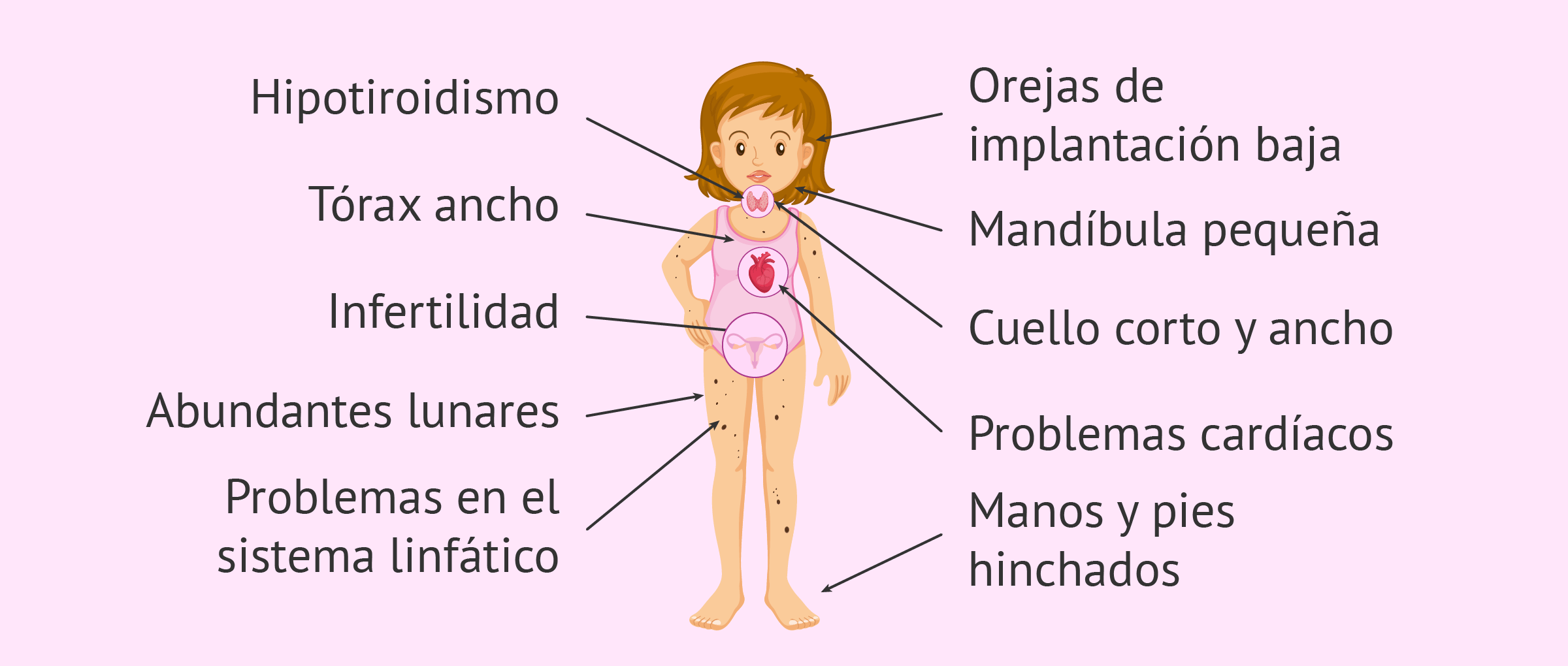 Características de mujeres con Síndrome de Turner. Foto: Reproducción Asistida