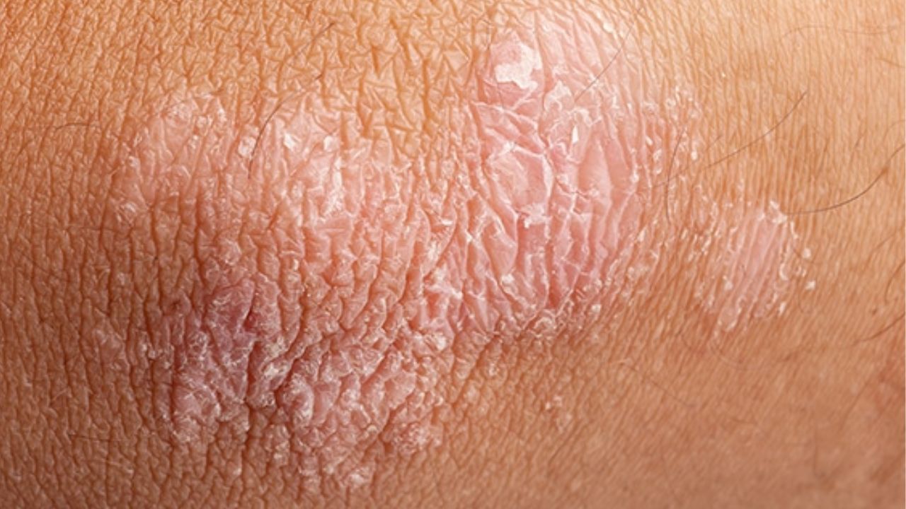 Imagen de ¿Qué es la psoriasis en la piel? Fotos, síntomas y cómo tratar la enfermedad