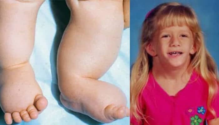 Los pies hinchados son uns de las características de padecer el Síndrome de Turner. Foto: NurSalud