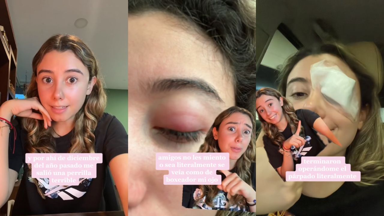 Joven visita el quirófano por seguir 'truco de belleza' de TikTok Imagen de Joven visita el quirófano por seguir 'truco de belleza' de TikTok
