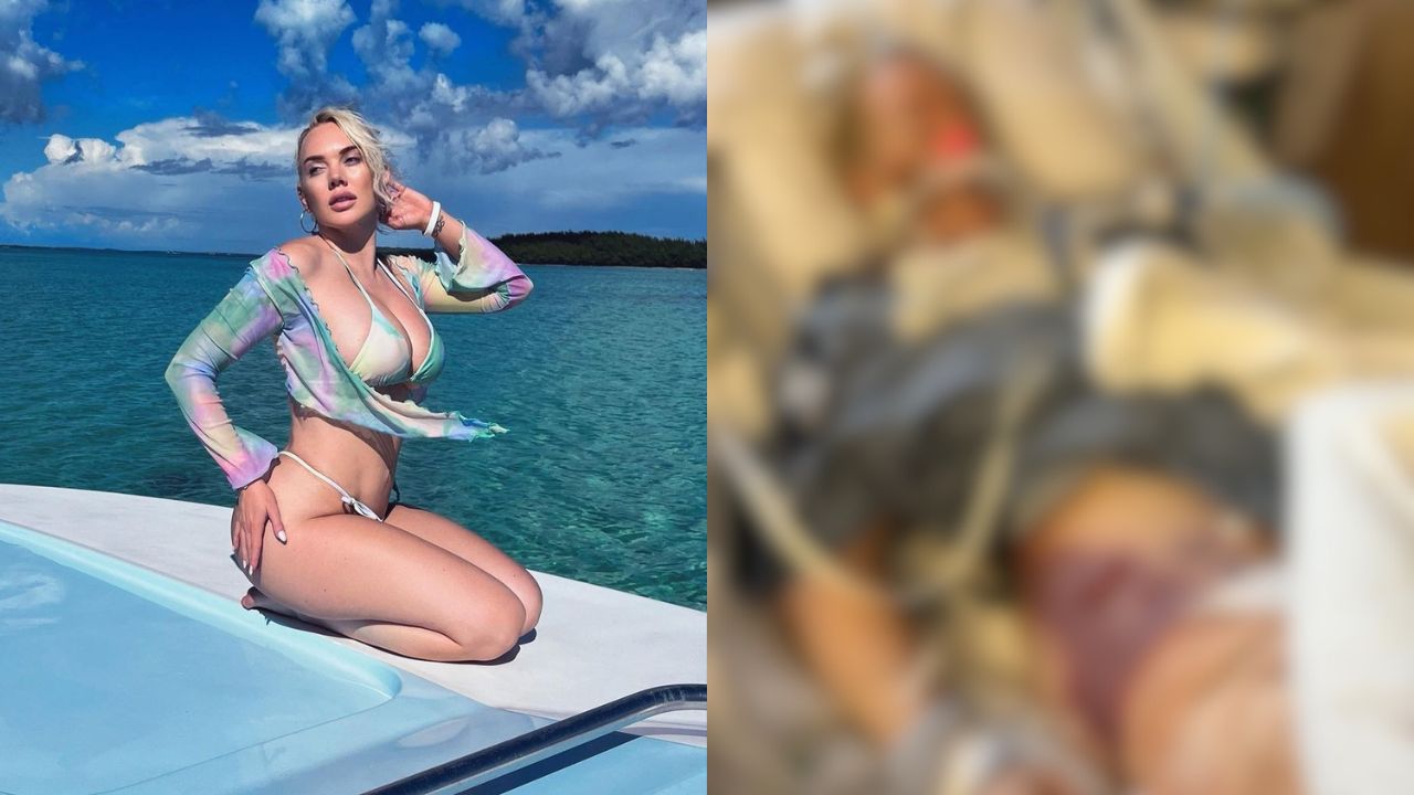 Imagen de Modelo fue amputada de una pierna tras infectarse con una bacteria come carne