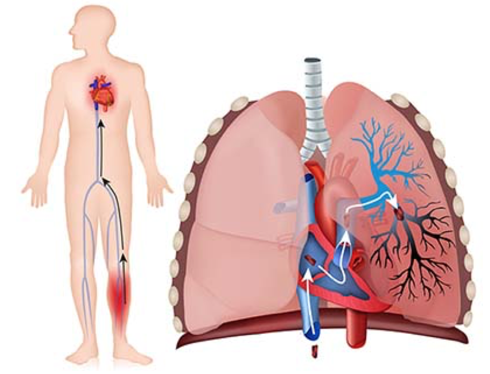Factores como la genética pueden causar la trombosis pulmonar. Foto: Fundación Española del Corazón