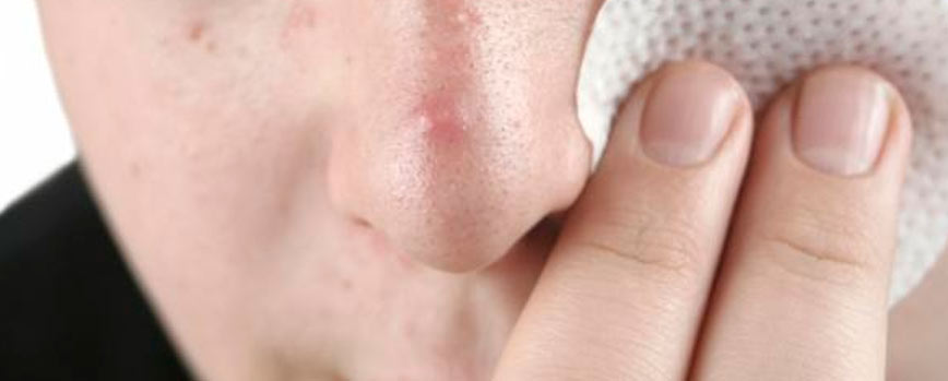 El explotar las espinillas puede ser peligroso por la cantidad de bacterias en las uñas y dedos.  Foto: DRUNI.es
