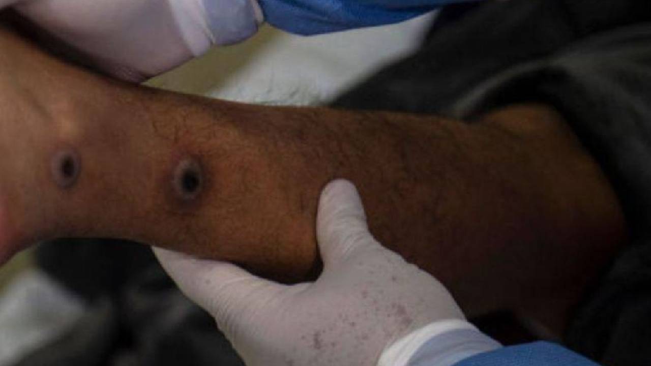 Imagen de Salud descarta caso de viruela del mono en Honduras