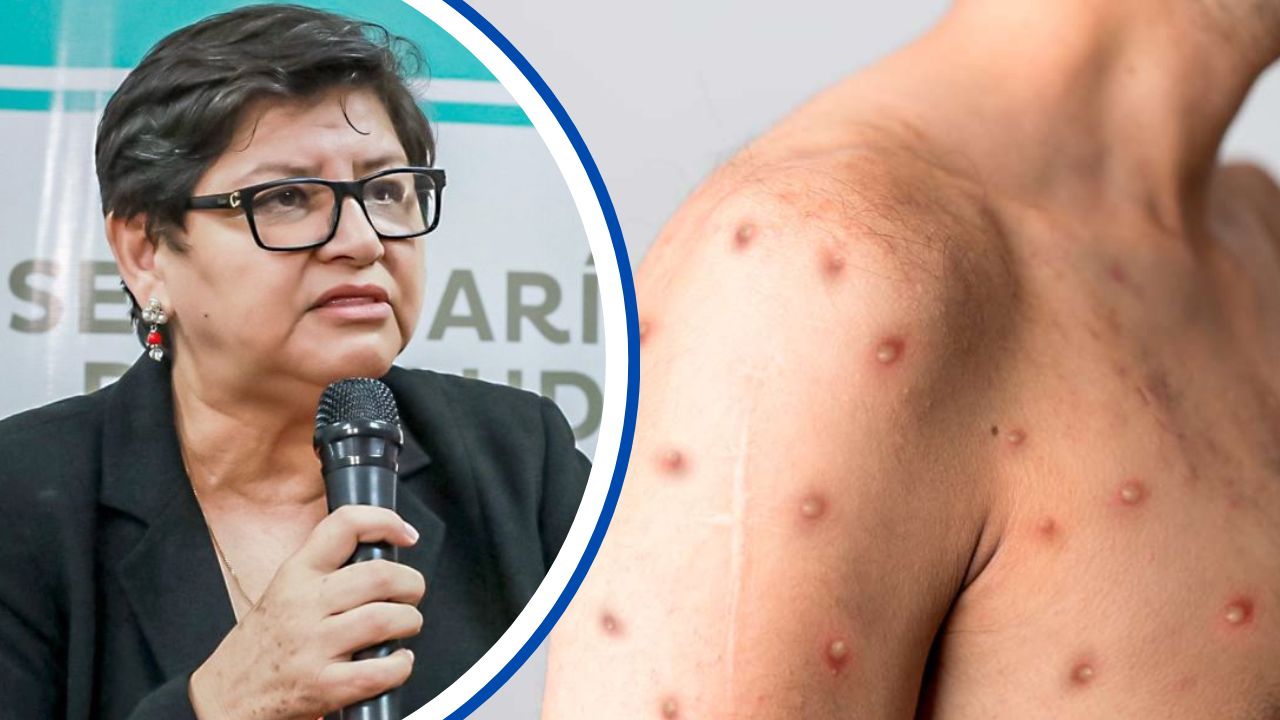 Imagen de Paredes: Familia en aislamiento por sospecha de viruela de mono, en Lempira