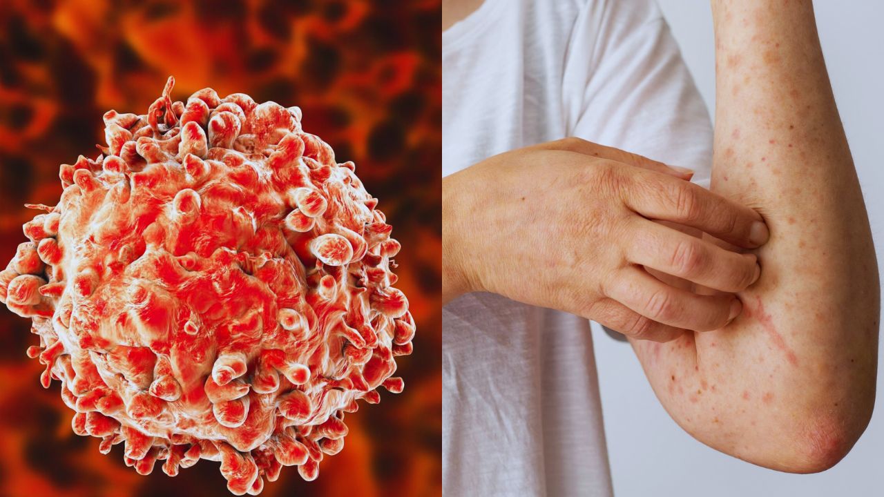 Dos imágenes de cómo se ve la leucemia con microscopio y cómo se ve en la piel.