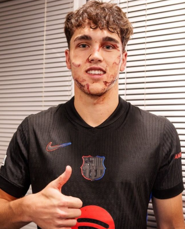 Foto de como quedó Pau Cubarsí después de recibir una patada en el rostro por un jugador del Estrella Roja de Belgrado