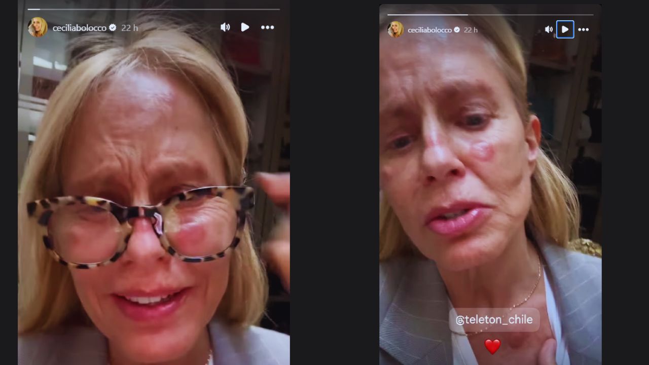 Imagen de Cecilia Bolocco qué le pasó en la cara a la ex Miss Universo chilena