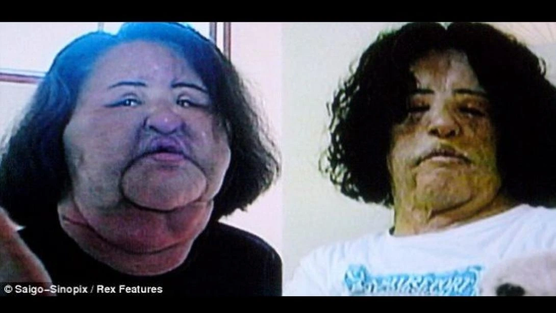 Hang Mioku se habría obsesionado con las cirugías por mantenerse joven y bella, pues buscaba tener una piel con apariencia lisa.