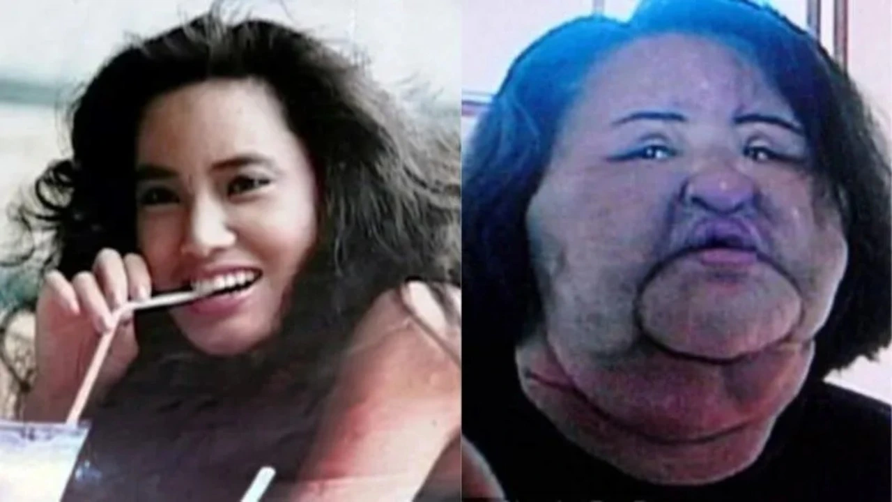 Una exmodelo se inyectó aceite en el rostro y quedó desfigurada Imagen de Una exmodelo se inyectó aceite en el rostro y quedó desfigurada