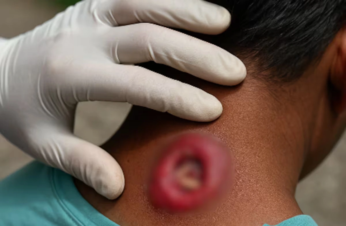 Los médicos han descrito la situación como "motivo de alarma", no solo por lo inusual de los casos, sino también por su severidad clínica. Foto: cortesía