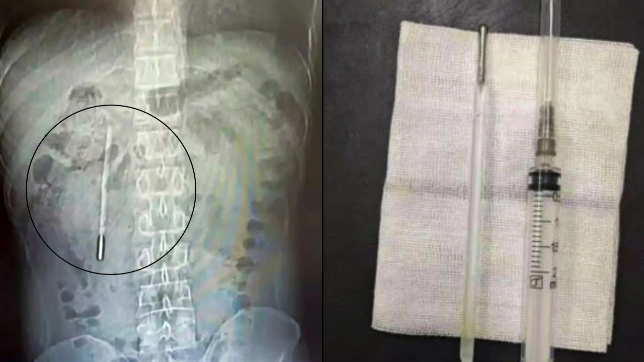 Hombre va al hospital por dolor abdominal y descubren un objeto en su interior Imagen de Hombre va al hospital por dolor abdominal y descubren un objeto en su interior