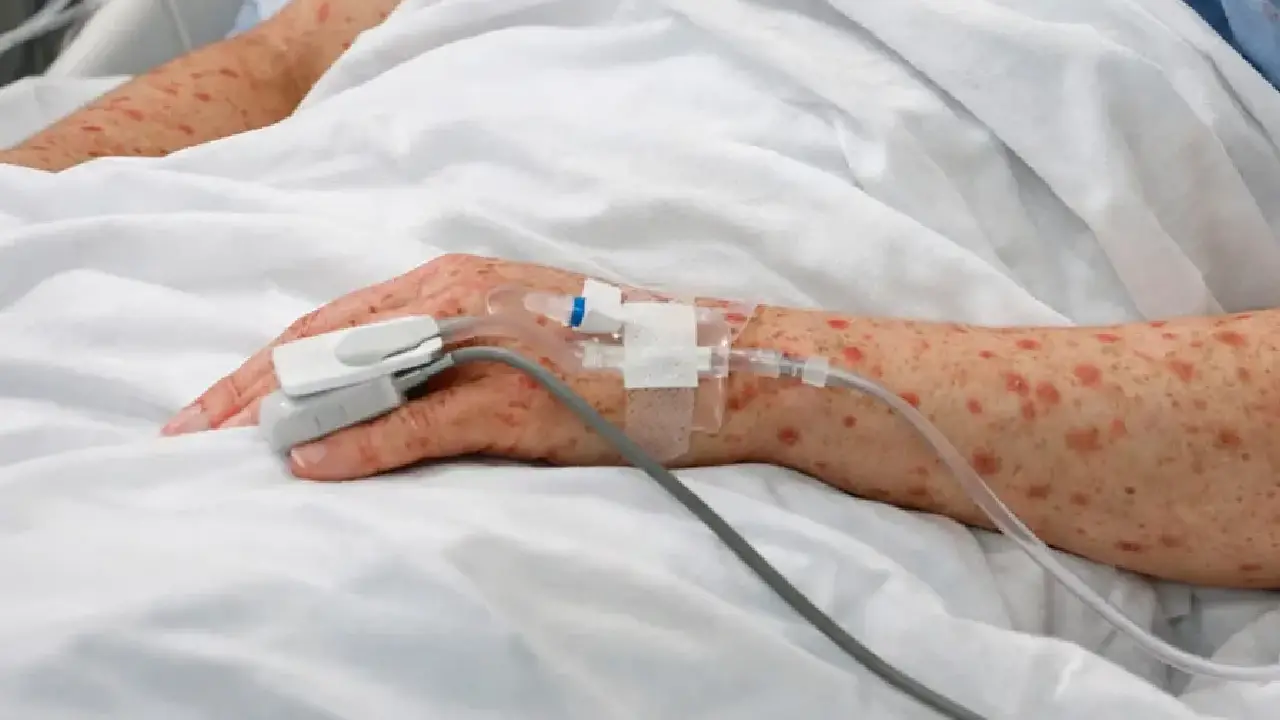 Imagen de Sarampión: estas son las complicaciones graves que pueden poner en riesgo la vida