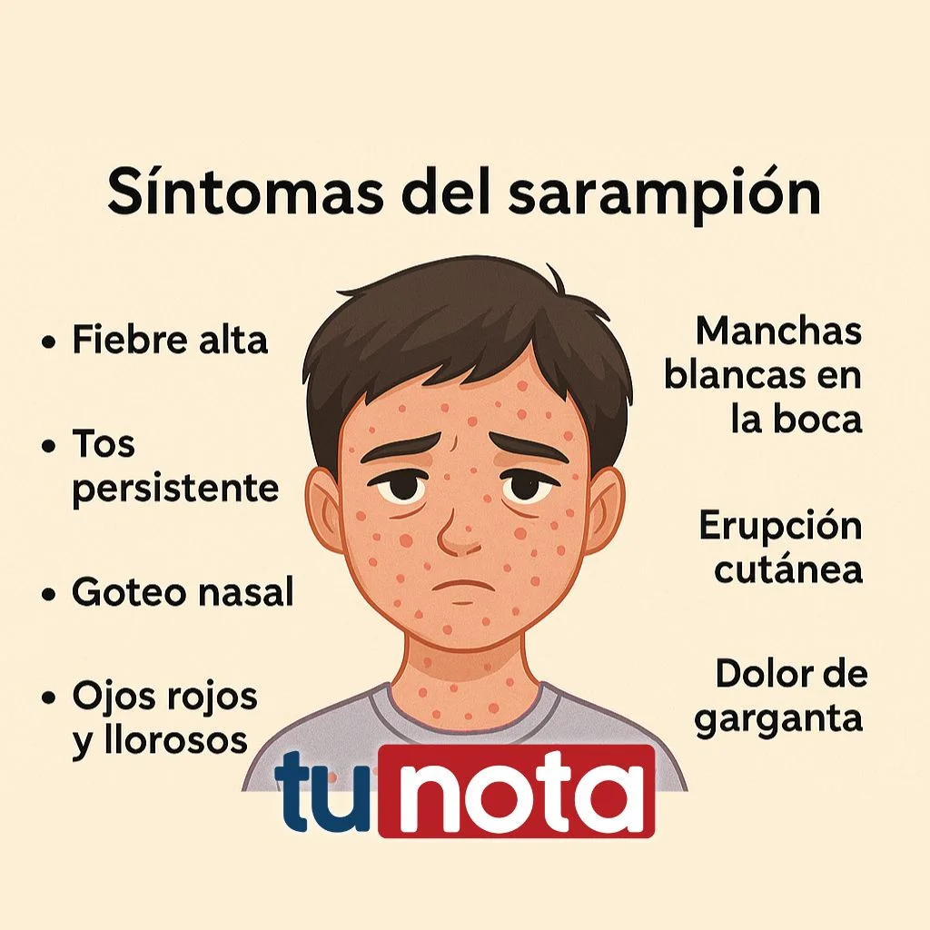 Síntomas del sarampión