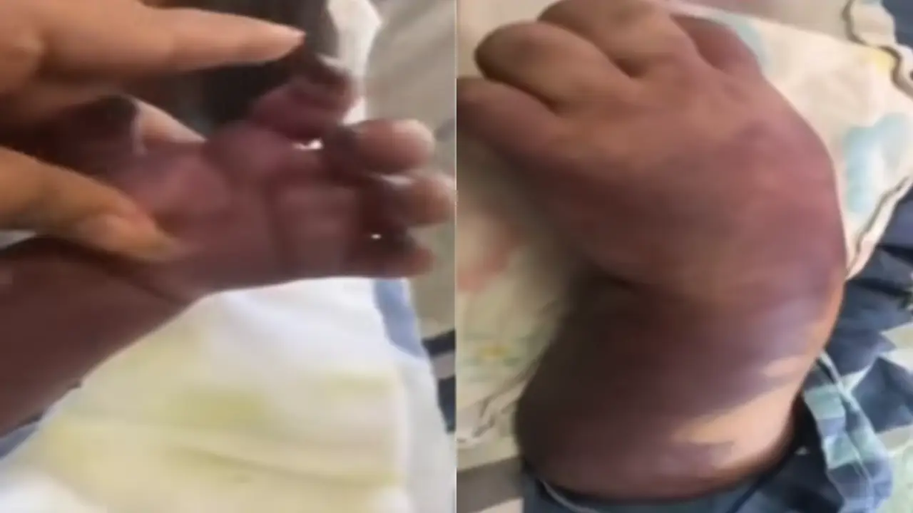 Niño de 2 años perdería brazo tras reacción a medicamento en HE; ingresó por fiebre Imagen de Niño de 2 años perdería brazo tras reacción a medicamento en HE; ingresó por fiebre