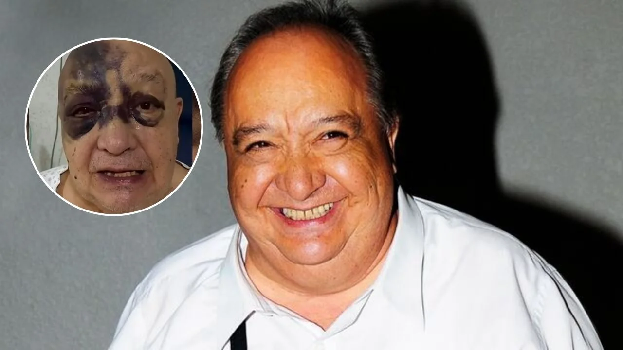 ¿Qué le pasó a Luis de Alba en la cara? La verdad detrás de los moretones Imagen de ¿Qué le pasó a Luis de Alba en la cara? La verdad detrás de los moretones