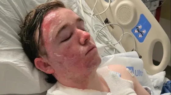 Jacob Smith, de 20 años, joven que resultó herido tras que su compañero de trabajo le lanzara agua hirviendo.