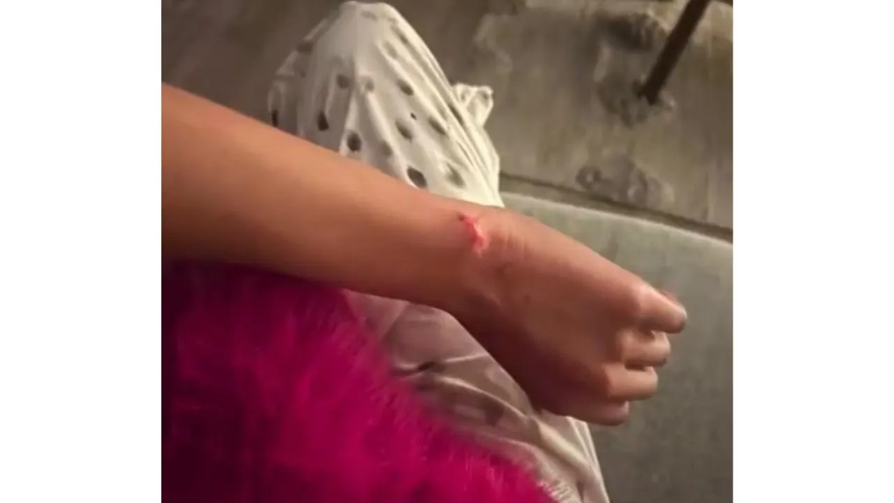 El brazo de Anamar maltratado por su expareja.