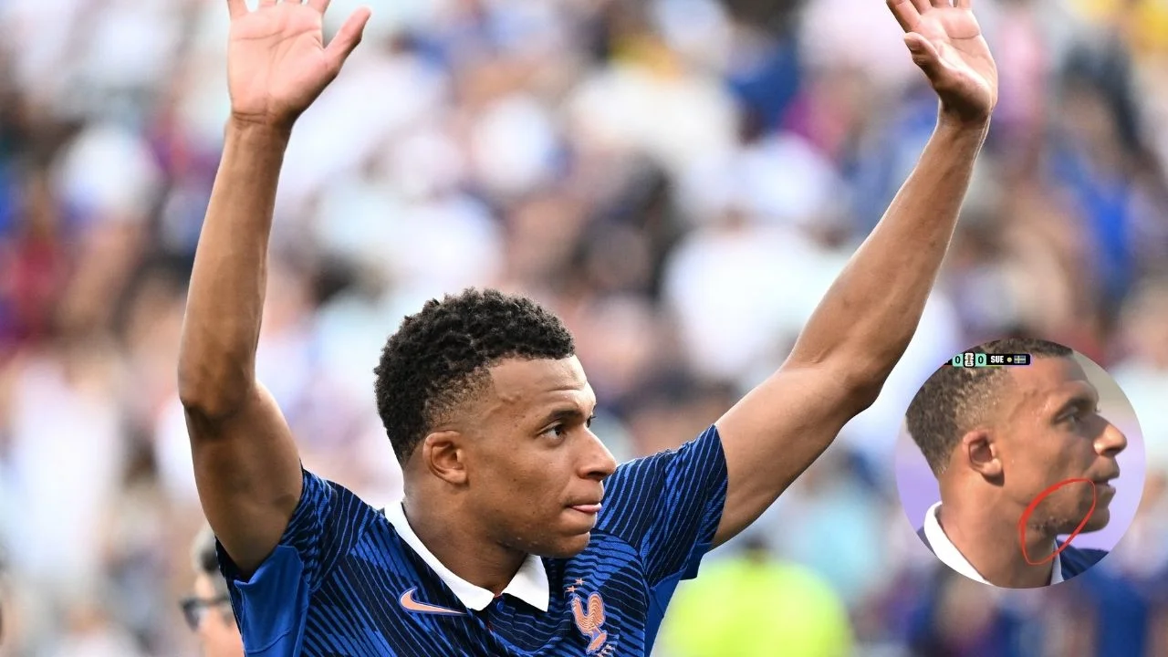 Imagen de La verdad detrás de las marcas en el cuello de Kylian Mbappé