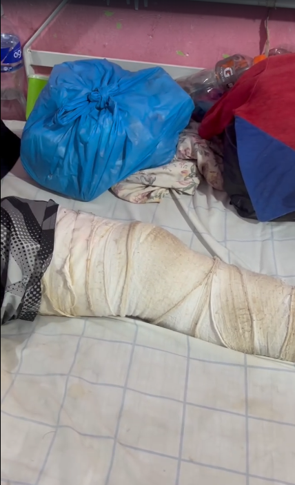 Foto de la pierna del hondureño al que médico le ayudará a pagar la cirugía