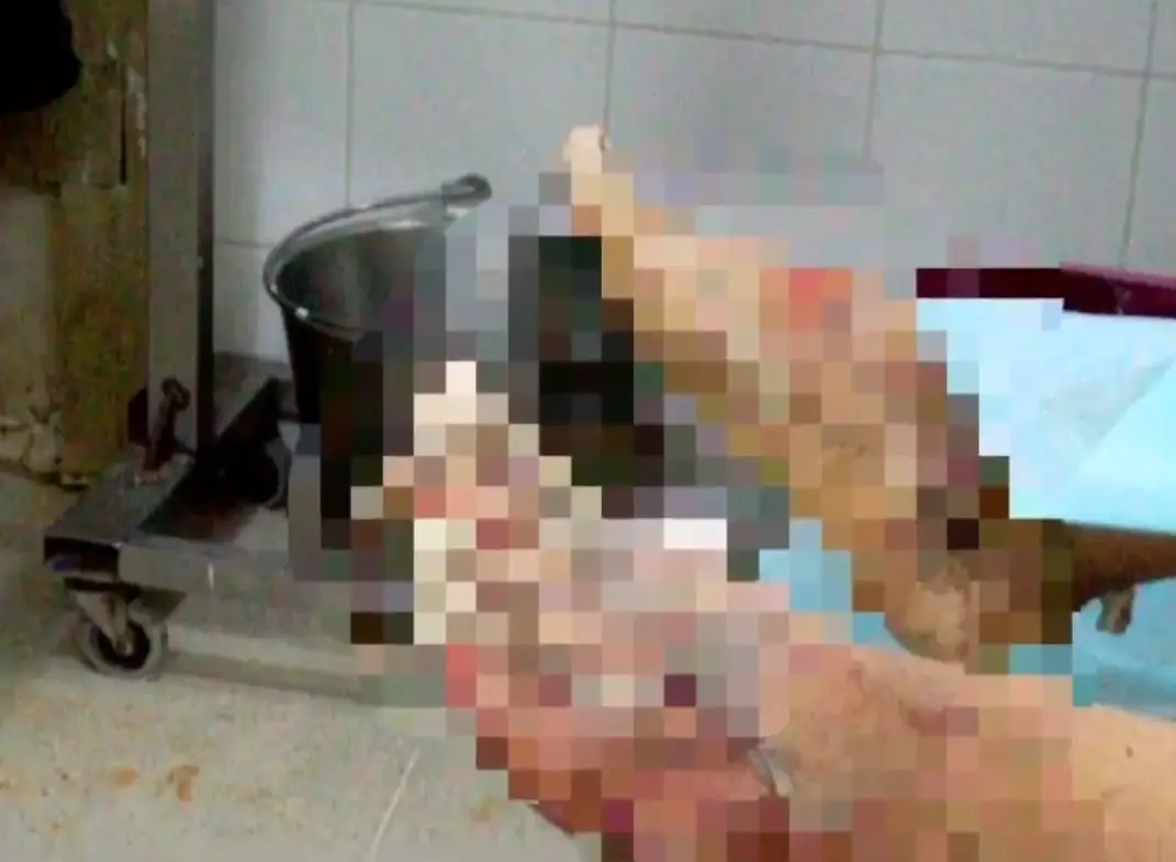 Joven ingresada con quemaduras