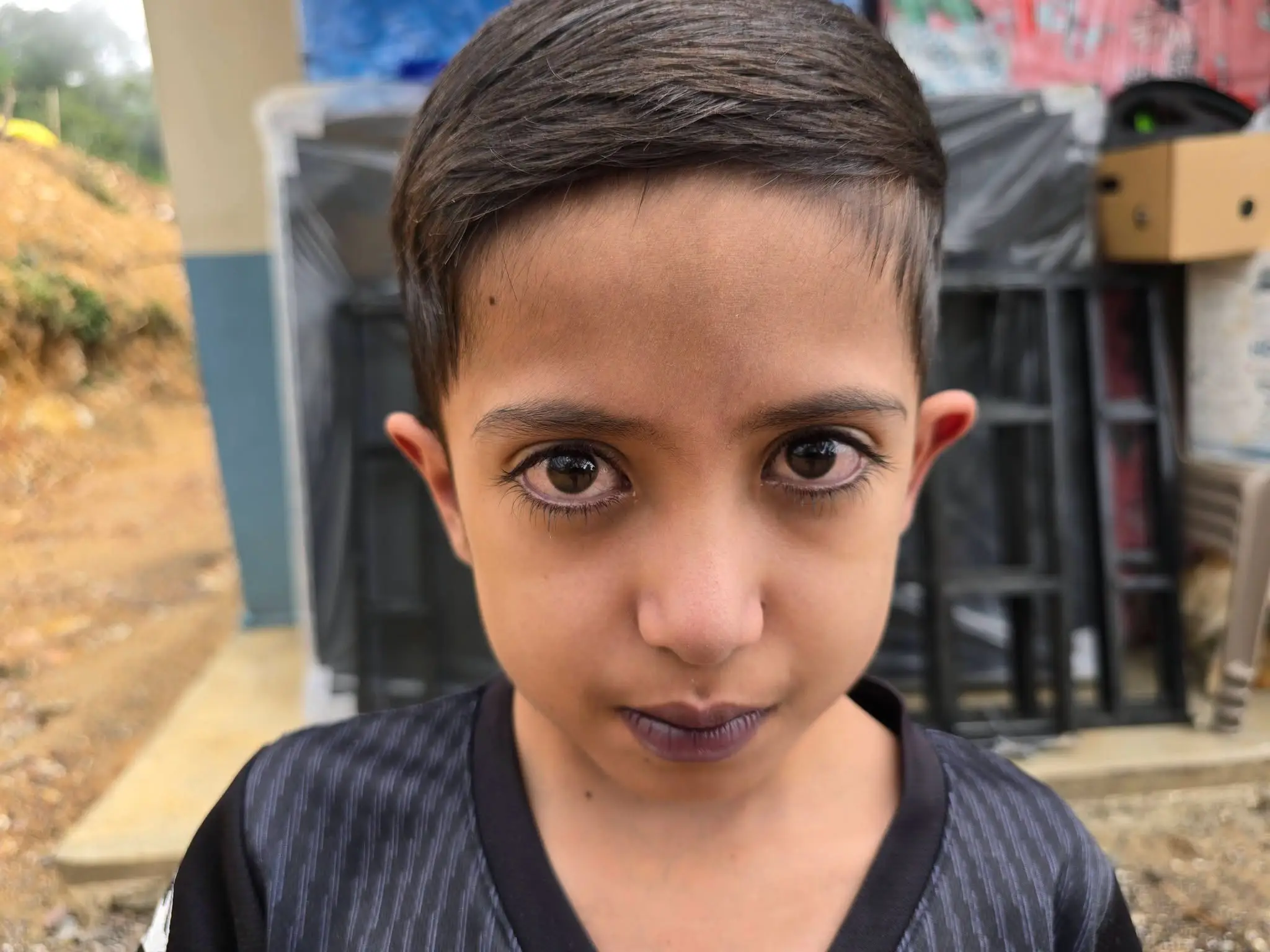 Josué Nehemías Cruz Cruz, niño hondureño que nació con el corazón al lado derecho