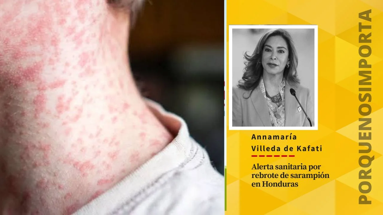 Alerta sanitaria por rebrote de sarampión en Honduras Imagen de Alerta sanitaria por rebrote de sarampión en Honduras