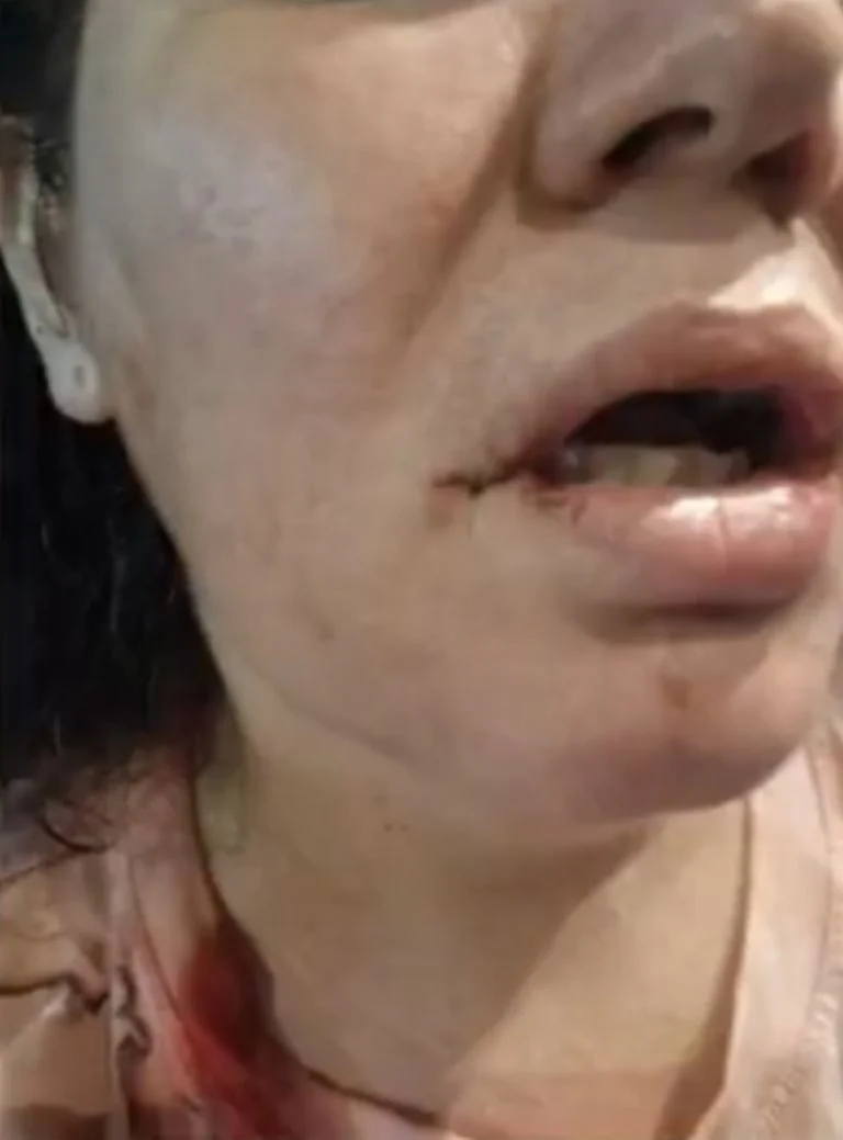 Labios rotos
