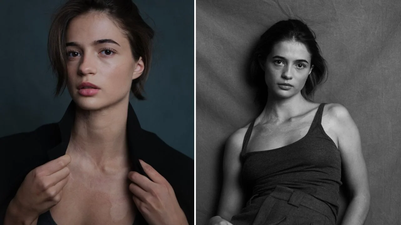 Lisa-Marie Koroll cicatriz: ¿Tiene una quemadura en el cuello, qué le pasó? Imagen de Lisa-Marie Koroll cicatriz: ¿Tiene una quemadura en el cuello, qué le pasó?